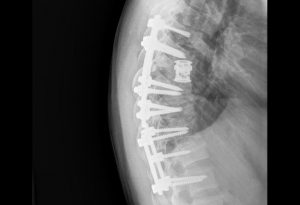 The extent of the screws inserted into Viktor's vertebrae to stabilise his spine